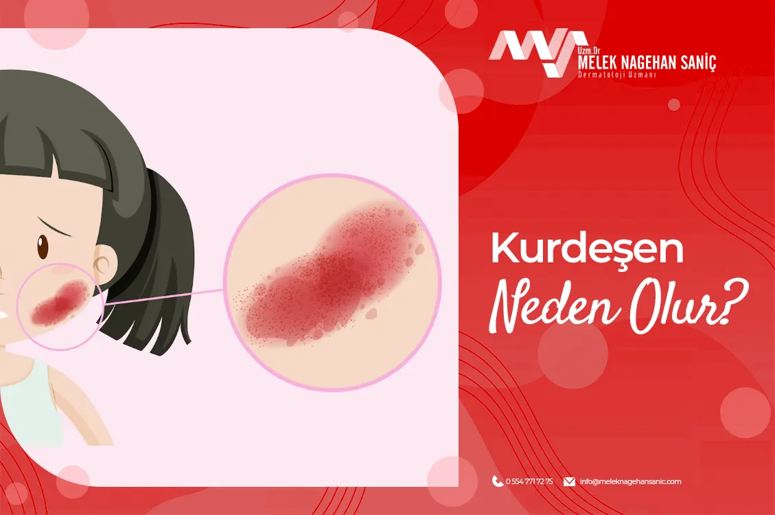 Kurdeşen Neden Olur?