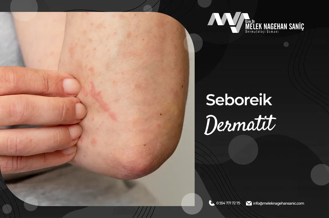 Seboreik Dermatit