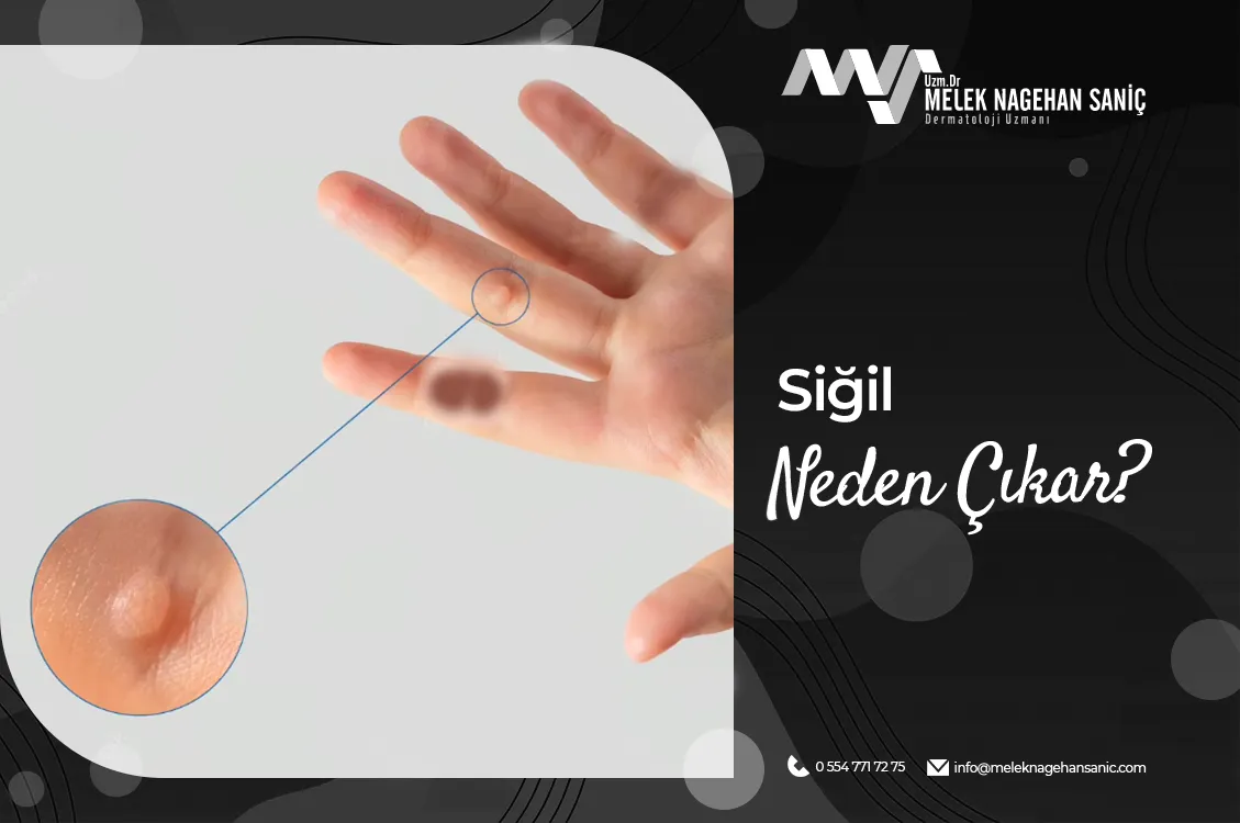 Siğil Neden Çıkar?