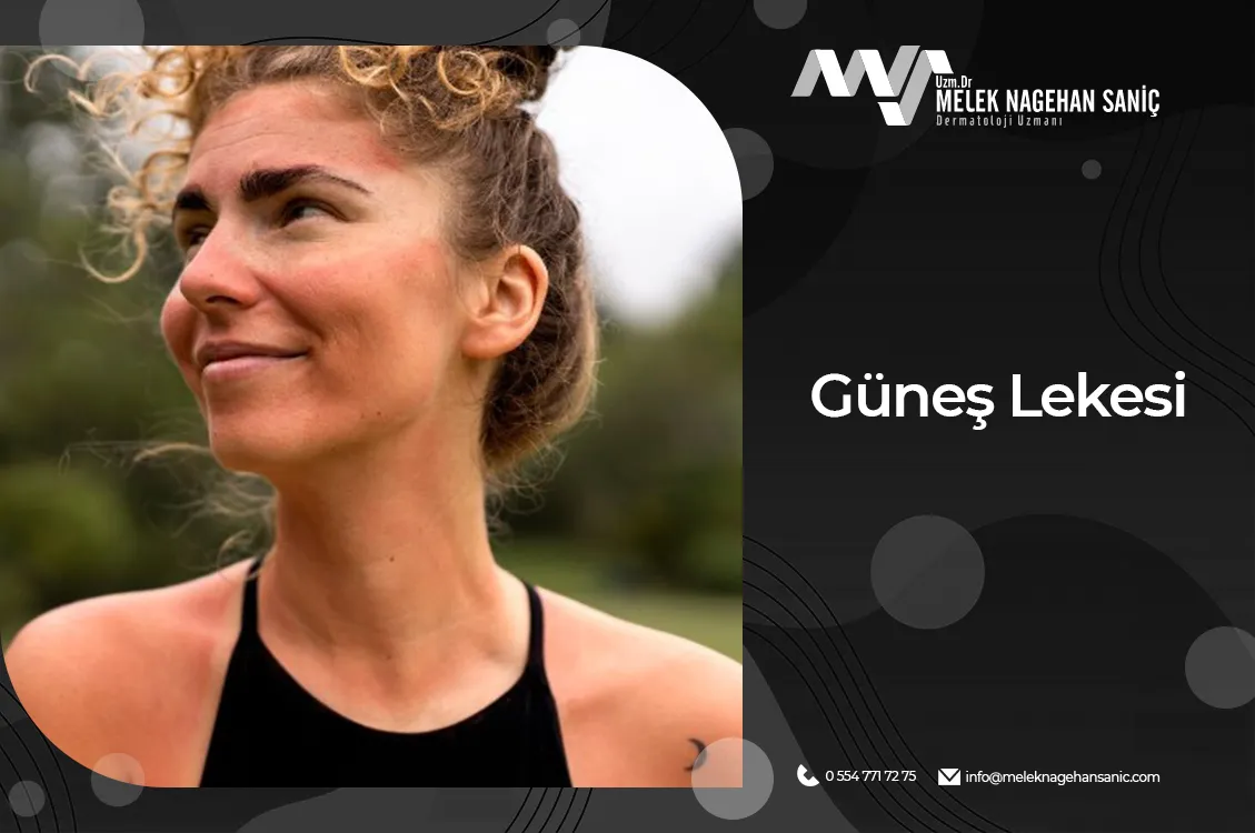 gunes-lekesi-01