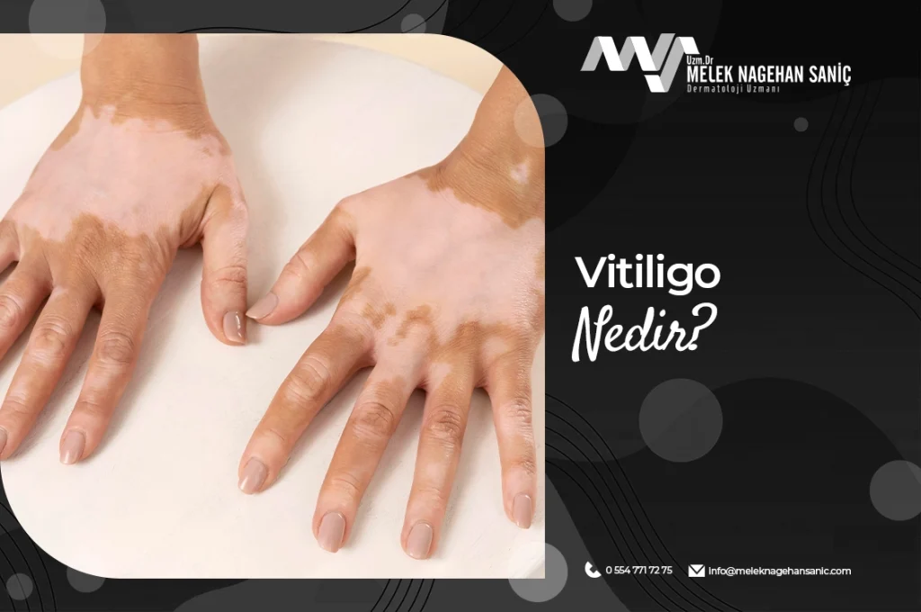 Vitiligo Nedir?