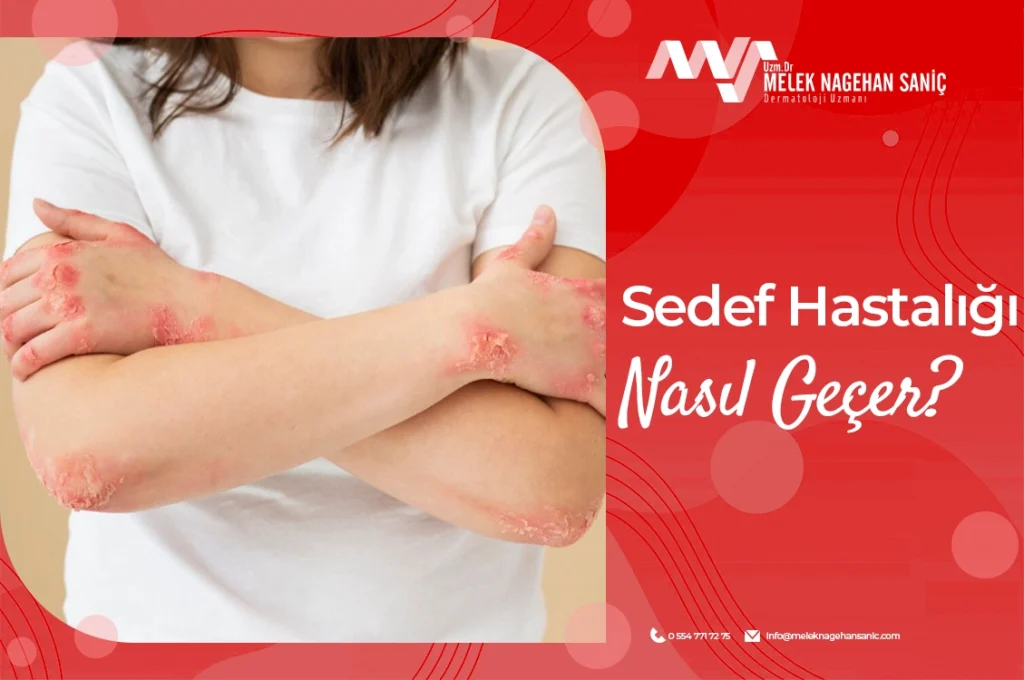 Sedef Hastalığı Nasıl Geçer?