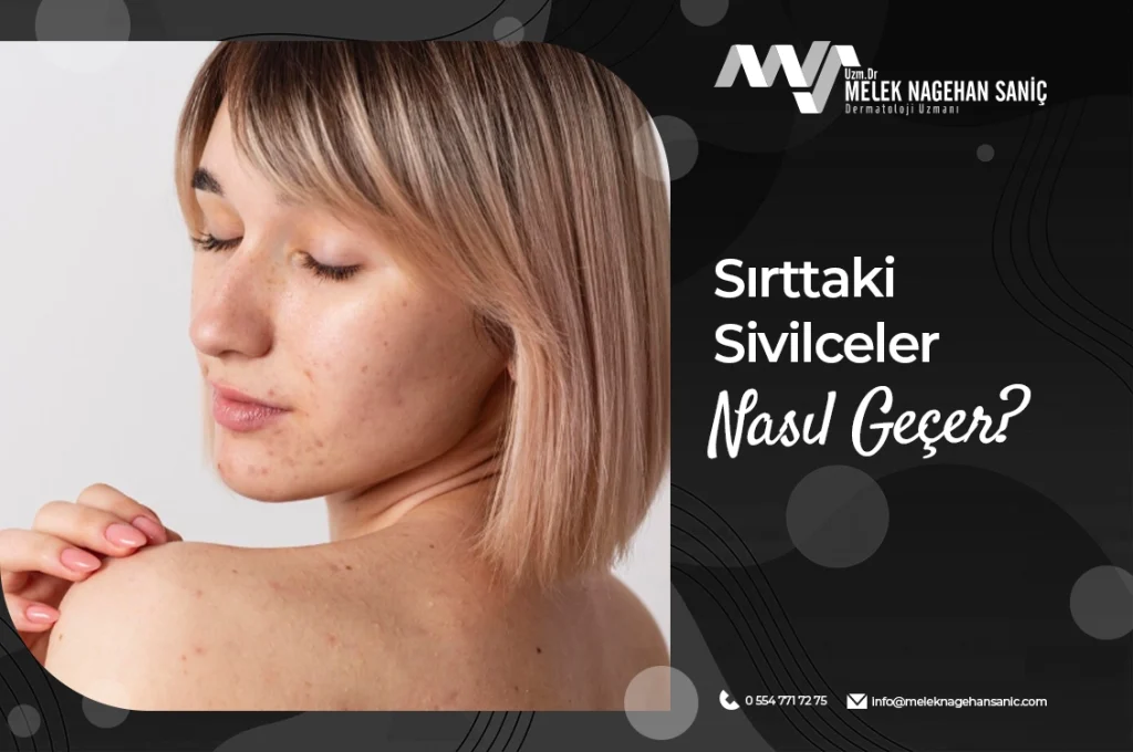 Sırttaki Sivilceler Nasıl Geçer?