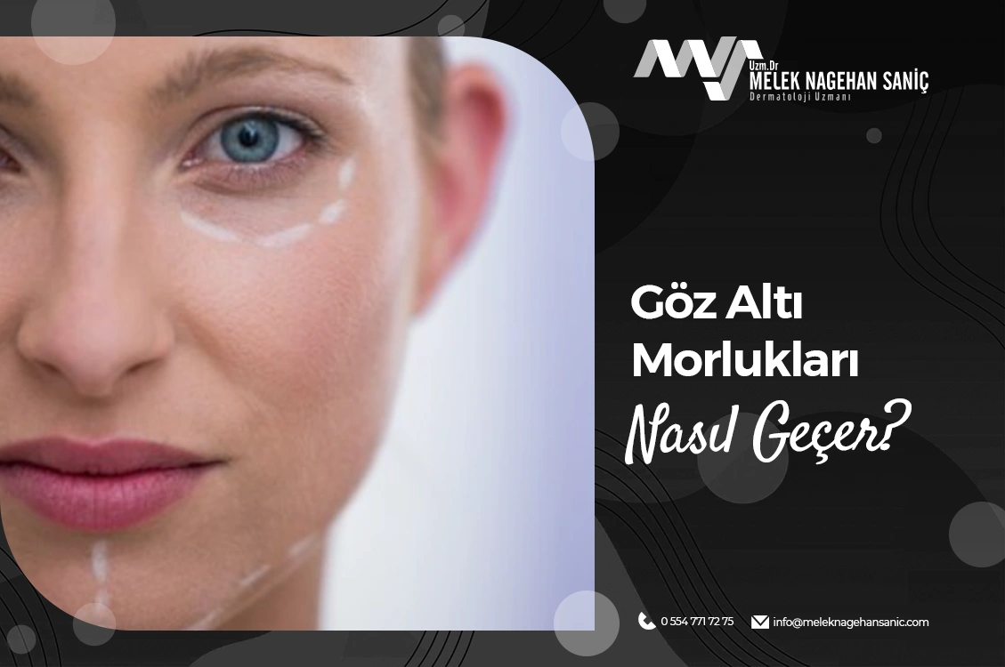 Göz Altı Morlukları Nasıl Geçer?