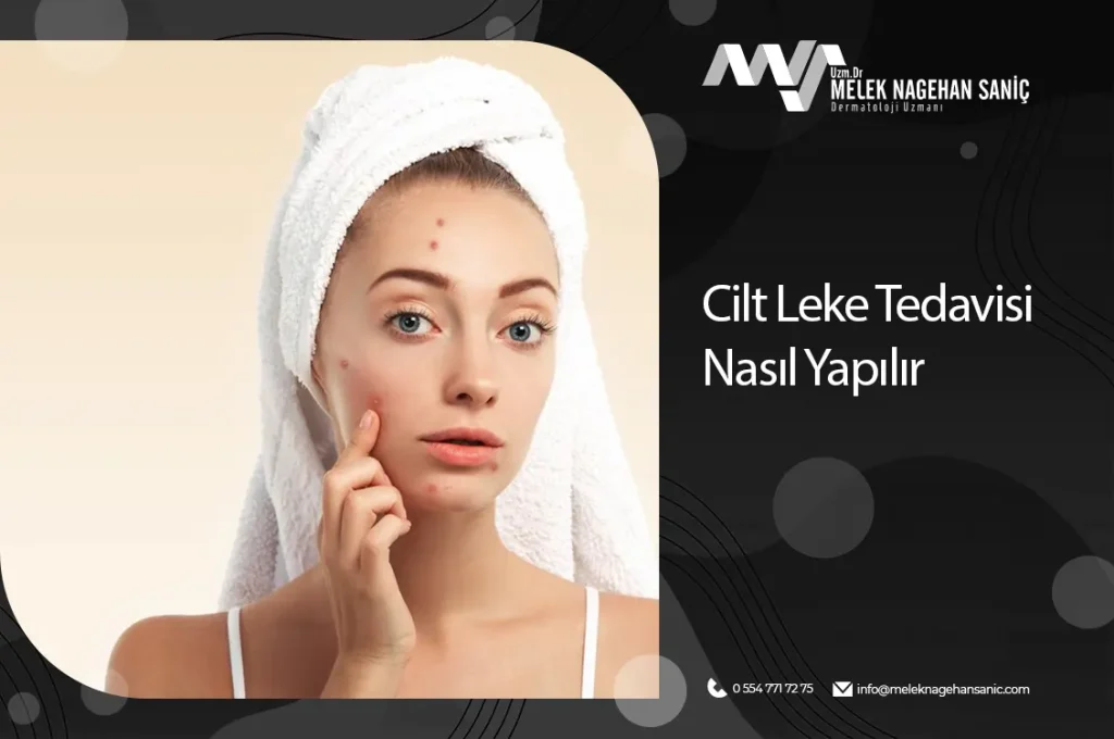 cilt leke tedavisi nasıl yapılır