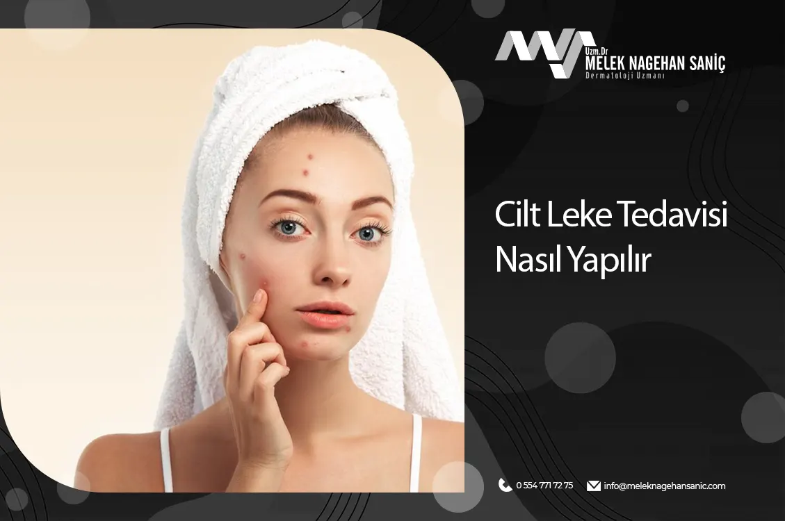cilt leke tedavisi nasıl yapılır