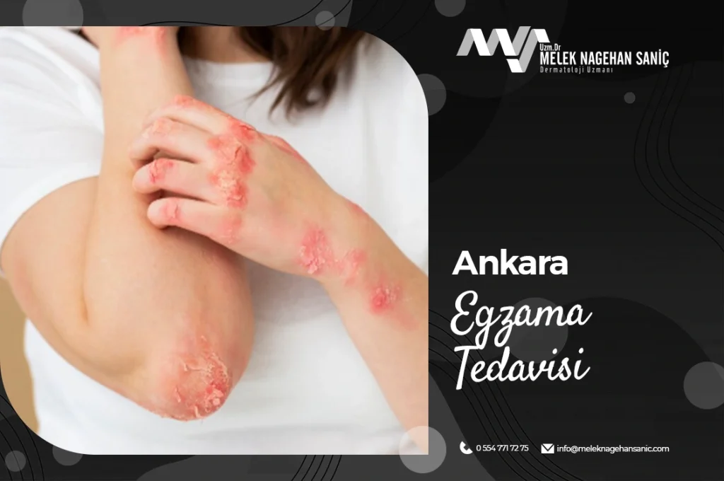 Ankara Egzama Tedavisi