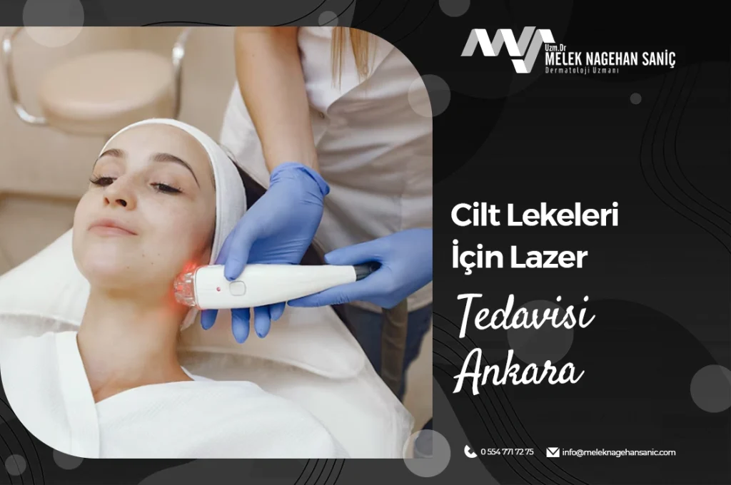 Cilt Lekeleri İçin Lazer Tedavisi Ankara