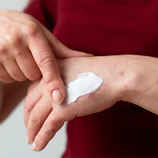 Atopik Dermatit