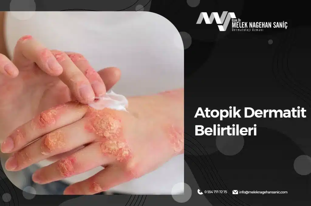 Atopik Dermatit Belirtileri