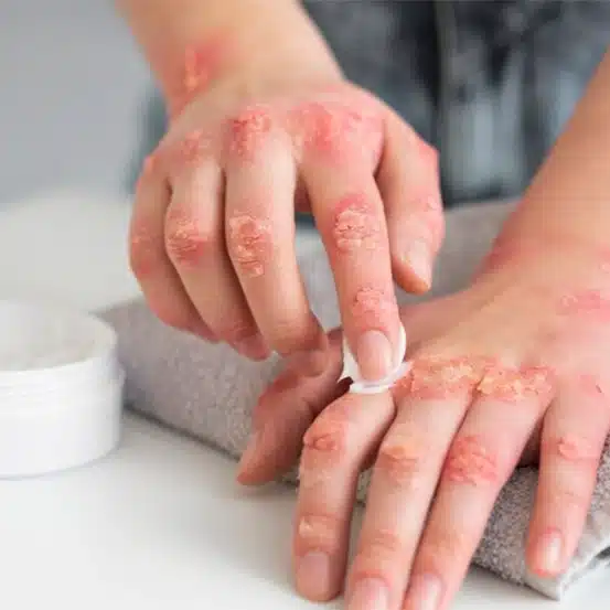 Atopik Dermatit Belirtileri