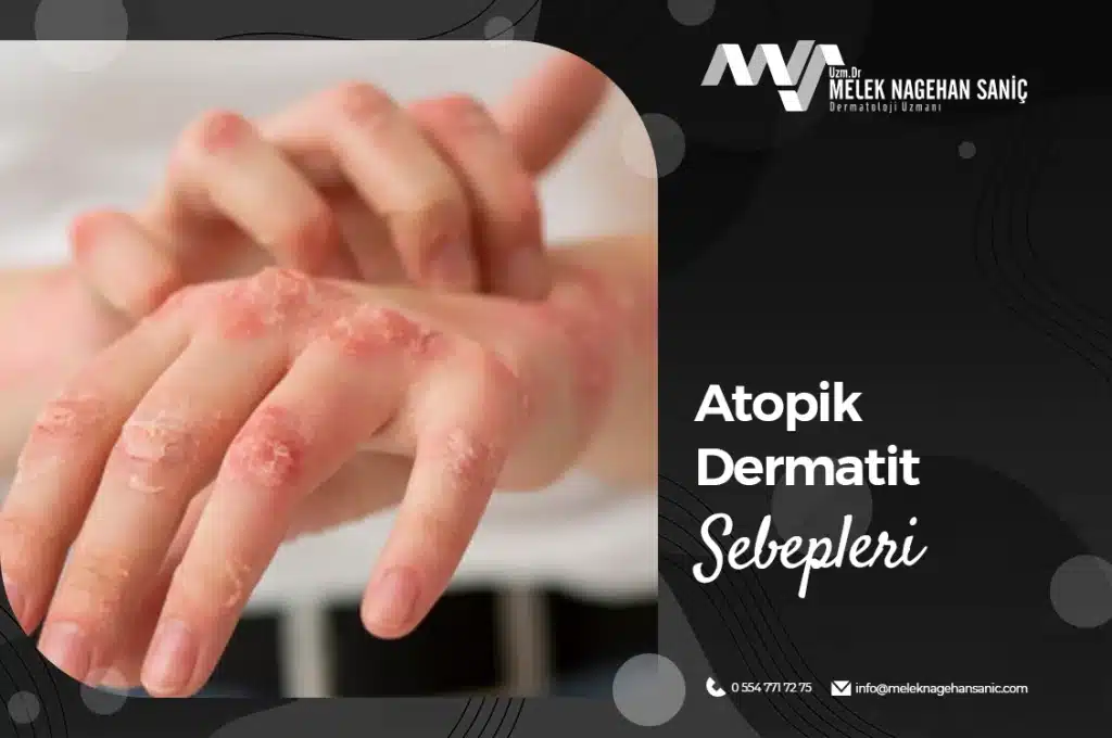 Atopik Dermatit Sebepleri