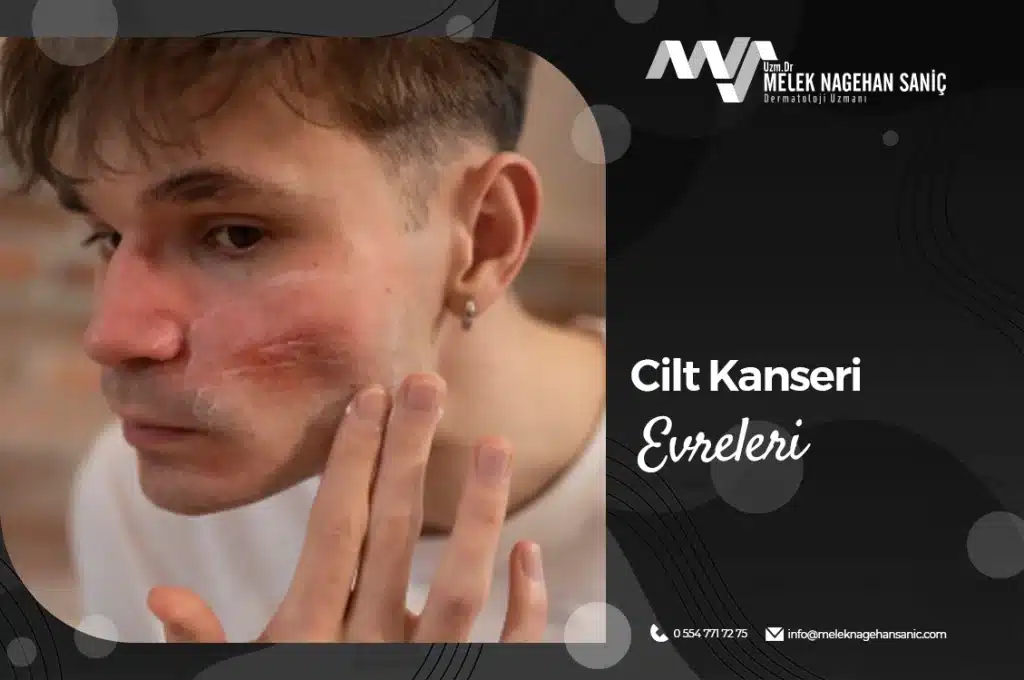 Cilt Kanseri Evreleri