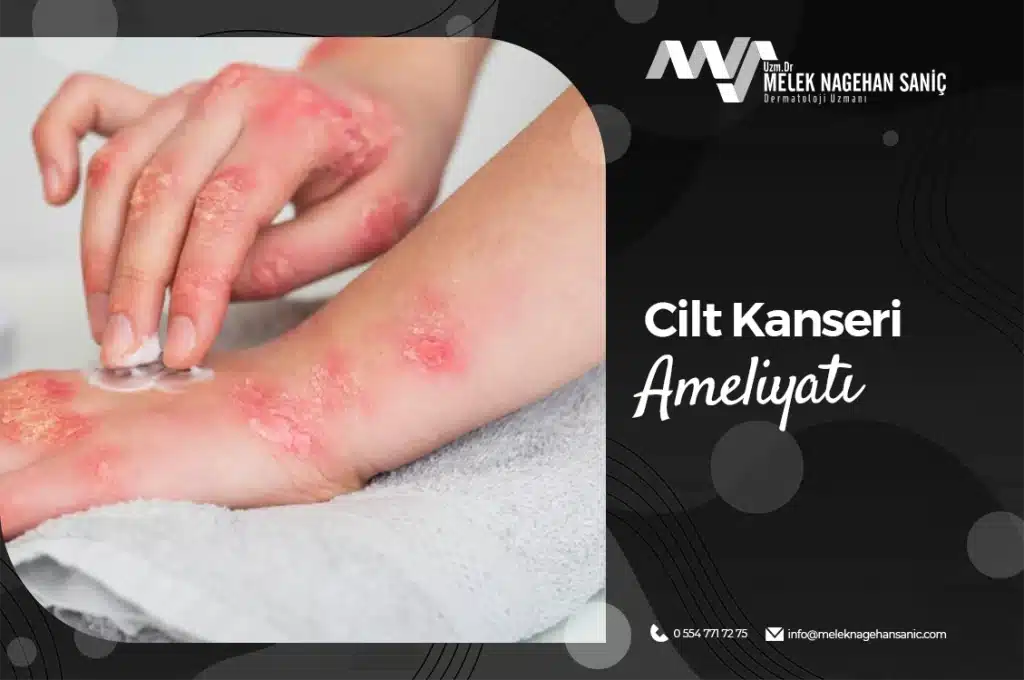 Cilt Kanseri Ameliyatı
