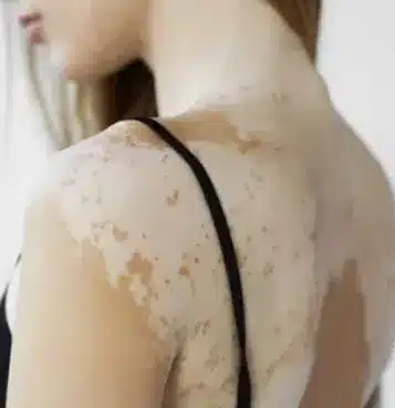 Ankara Dermatoloji Uzmanı